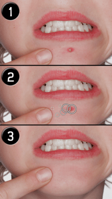 Скриншот приложения Pimple Eraser LITE - №7